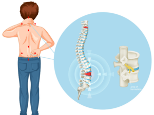 Đau vùng thắt lưng thường xảy ra những cơn đau âm ỉ vùng lưng dưới