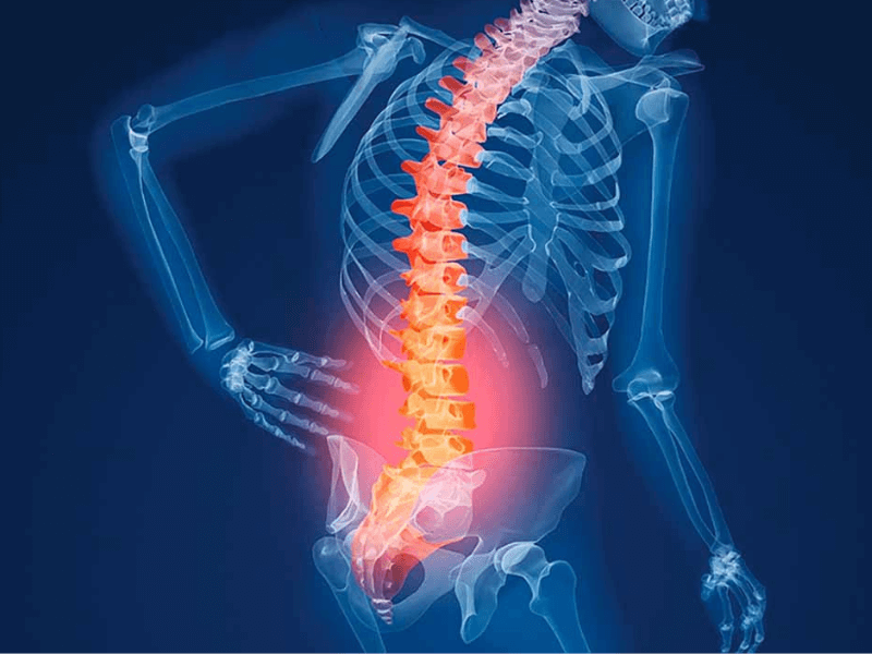 Loãng xương là một trong những nguyên nhân gây đau lưng dưới