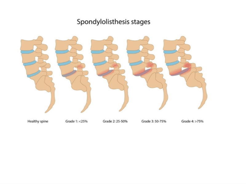 Các mức độ của trượt cột sống thắt lưng