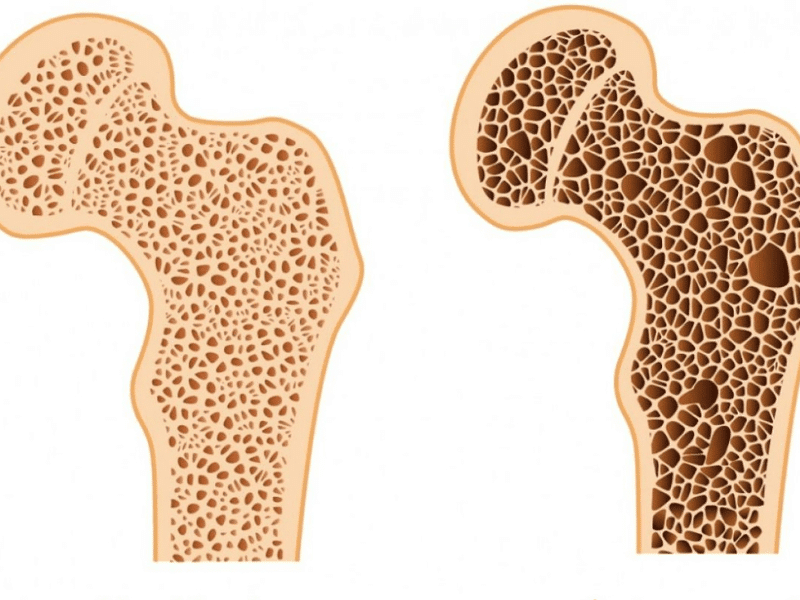 Loãng xương cũng là nguyên nhân gây đau lưng ở người lớn tuổi 2