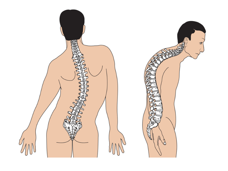 Một số thói quen hằng ngày làm cong vẹo cột sống là nguyên nhân đau thắt lưng