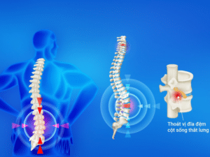 Thoát vị đĩa đệm cột sống thắt lưng là bệnh xương khớp rất phổ biến