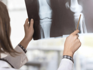 Chụp X-quang để chấn đoán bệnh thoái hóa khớp gối