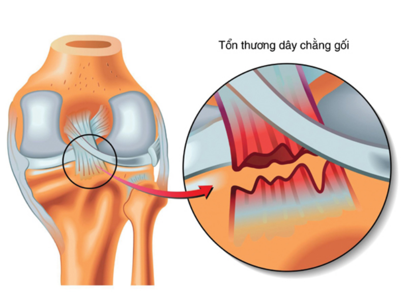 Chấn thương dây chằng chéo trước là tình trạng thường gặp của chấn thương đầu gối