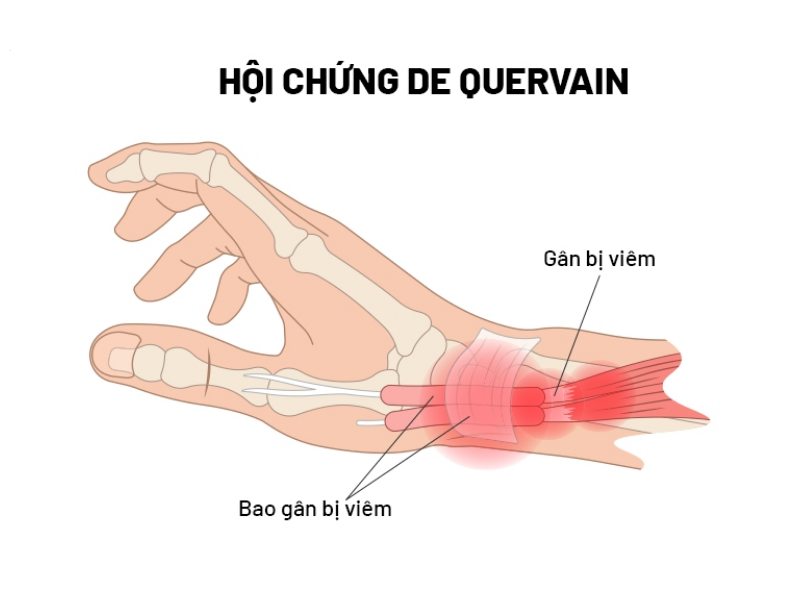 Hội chứng De Quervain là nguyên nhân gây đau cổ tay sau sinh phổ biến