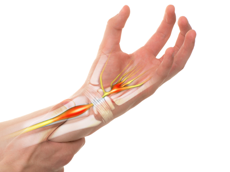  Hội chứng ống cổ tay xảy ra khi thần kinh giữa bị chèn ép khi đi ngang qua ống cổ tay 1