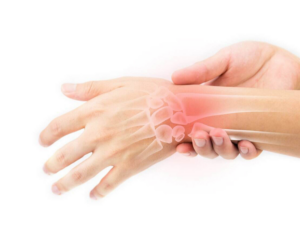  Triệu chứng viêm bao gân cổ tay thường gặp không nên bỏ qua!