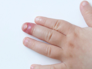Chín mé ngón tay có nguy hiểm không? Cách phòng tránh hiệu quả