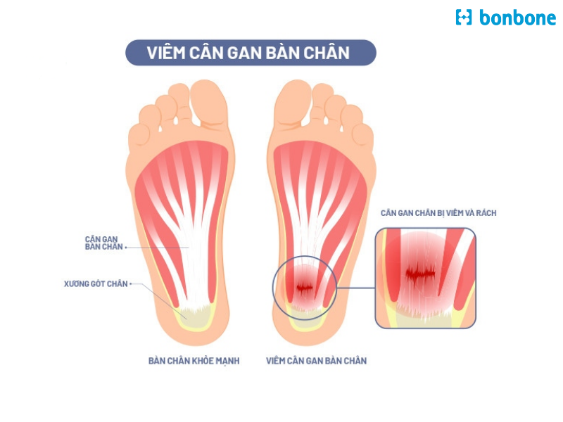 Viêm cân gan chân là một nguyên nhân phổ biến gây đau gót chân