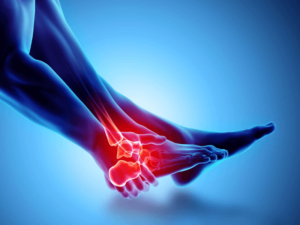Bong gân khớp cổ chân: Những điều cần biết và cách chữa trị hiệu quả