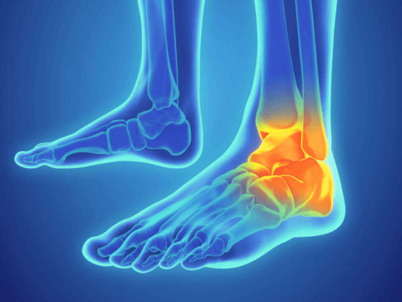 Bong gân khớp cổ chân: Những điều cần biết và cách chữa trị hiệu quả 2