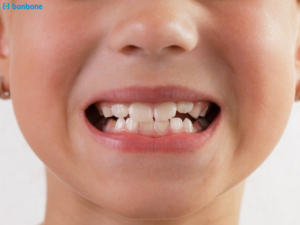 Lệch khớp cắn ảnh hưởng tới chức năng răng và thẩm mỹ khuôn mặt như thế nào?