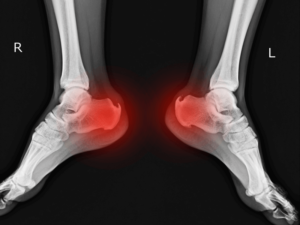 Bệnh gai gót chân là gì? Nguyên nhân, triệu chứng và cách điều trị hiệu quả