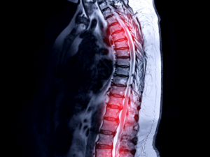 Trật khớp sống lưng có nguy hiểm không? Tìm hiểu nguyên nhân và cách điều trị hiệu quả