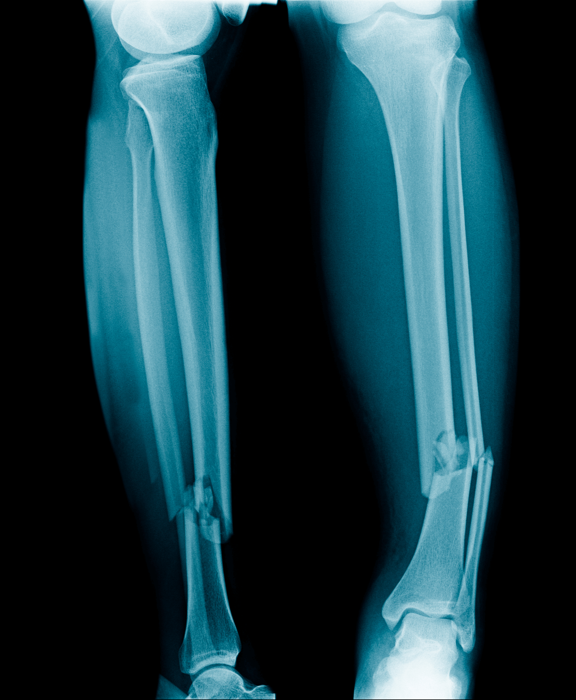 Chụp X-quang cẳng chân