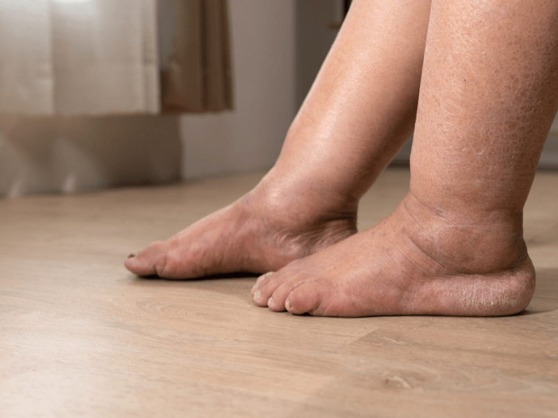 Viêm dây chằng cổ chân (Achilles tendonitis)