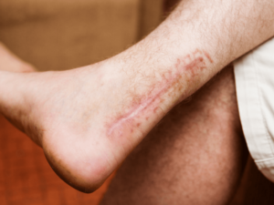 Chấn thương cổ chân: Các loại chấn thương phổ biến và cách điều trị