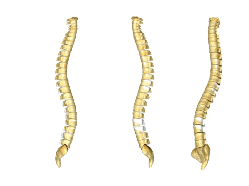 Nguyên nhân gây ra gai xương thoái hóa cột sống thắt lưng