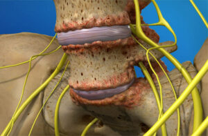 Thoái hóa cột sống thắt lưng m47: Nguyên nhân, triệu chứng và cách điều trị