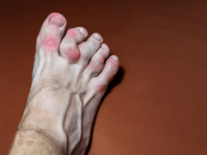 Các biến chứng của bệnh gout có thể dẫn đến những hậu quả nào?