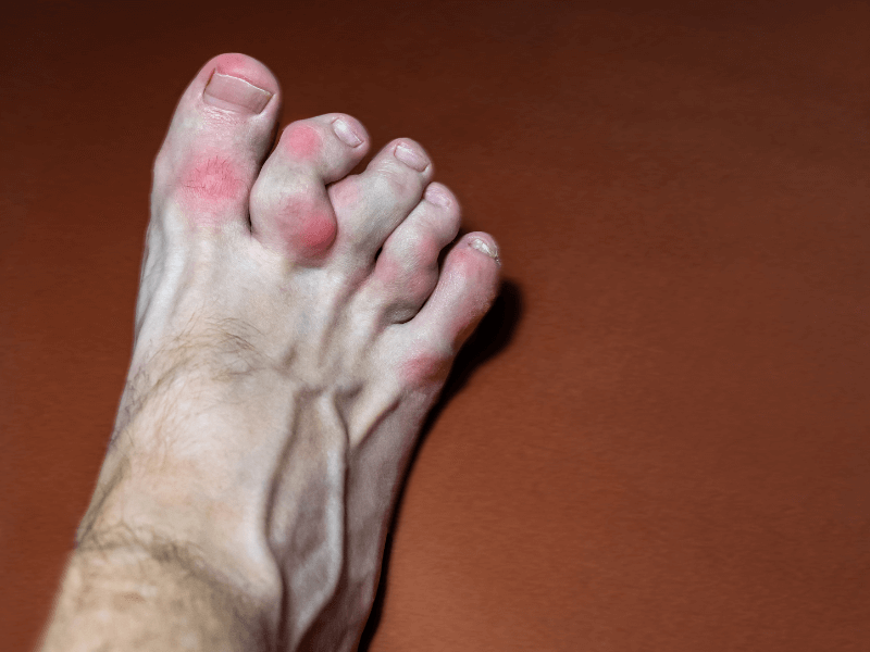 Biến chứng của gout là gì?