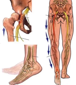 Đau dây thần kinh tọa chân trái: Nguyên nhân, triệu chứng và cách điều trị hiệu quả