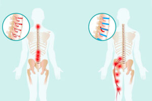 Đau dây thần kinh tọa ở mông: Tình trạng đau nhức dọc theo dây thần kinh hông to