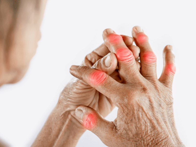 Tìm hiểu về các triệu chứng đặc trưng của bệnh gút ở cổ tay