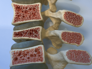 Bổ sung canxi cho người thoái hóa cột sống: Tăng cường sức khỏe xương và giảm triệu chứng đau nhức