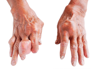 Dấu hiệu bệnh gút ở tay: Đừng bỏ lỡ các tín hiệu cảnh báo này
