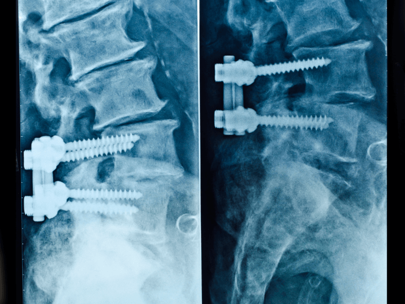 Nội dung phẫu thuật nẹp vít cột sống thắt lưng