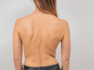 Tại sao lại xuất hiện gù lưng 1 bên? Nhận biết và điều trị