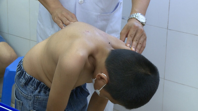 Biểu hiện gù lưng ở trẻ sơ sinh mà phụ huyên cần phải biết