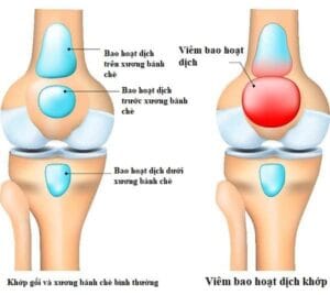 Nguyên nhân và chẩn đoán đau lưng do viêm màng hoạt dịch