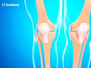 Đau gối khi chạy xuống dốc: Nguyên nhân chi tiết và biện pháp phòng tránh hiệu quả