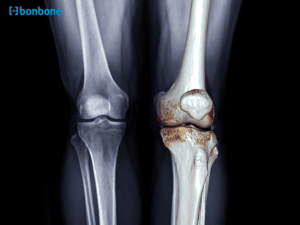 Cách nhận biết và phòng ngừa thoái hóa khớp: Hướng dẫn chi tiết từ kiến thức cơ xương khớp