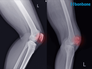 Dấu hiệu và triệu chứng của hội chứng Runner’s Knee