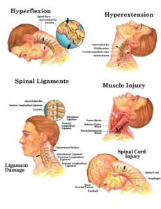 Chấn thương roi vọt (Whiplash): Hồi phục trong bao lâu?