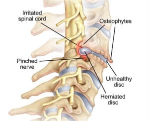 Hội chứng chèn ép rễ thần kinh cổ (Cervical radiculopathy): Cách điều trị