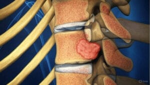 Hội chứng chùm đuôi ngựa (Cauda equina syndrome): Dấu hiệu nhận biết