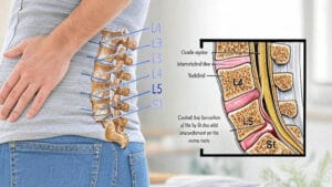 Đau thần kinh tọa do thoát vị đĩa đệm L5-S1: Nguyên nhân, triệu chứng và cách điều trị