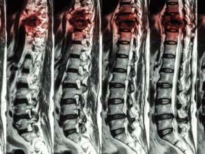 Nhiễm trùng cột sống thắt lưng (Lumbar osteomyelitis): Dấu hiệu cảnh báo