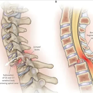 Viêm màng não tủy ảnh hưởng đến cột sống cổ: Dấu hiệu nguy hiểm