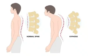 Đai chống gù lưng cho học sinh cấp 2: Giải pháp giúp con tự tin với vóc dáng tuổi teen!