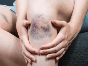 Đai khớp gối chống trượt: Giải pháp tối ưu cho thể thao cường độ cao