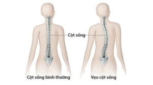 Đeo sai cách có gây cong vẹo cột sống ở trẻ? – Những điều phụ huynh cần biết