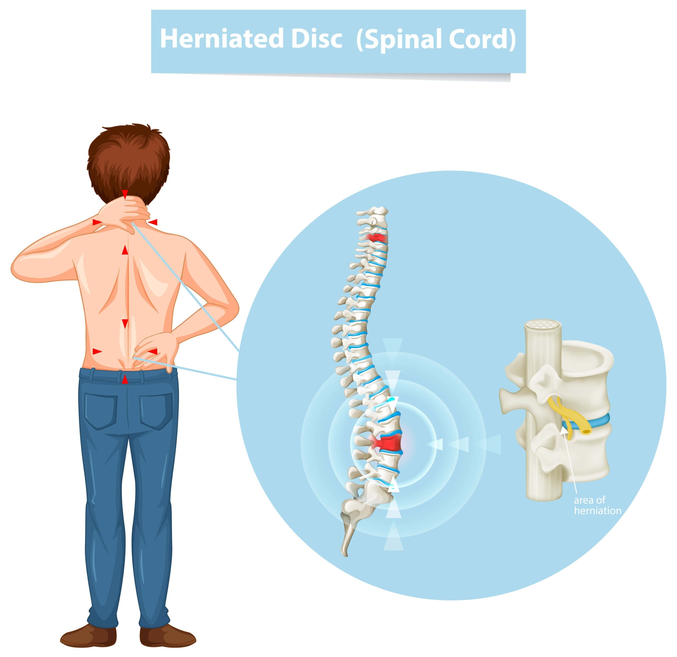 Phân loại các mức độ cong vẹo cột sống theo y khoa